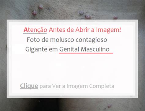 Molusco Contagioso: 12 Tratamentos Caseiros,。